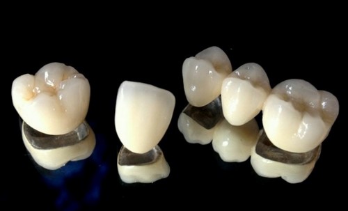 روکش زینتی دندان: تاریخچه، فواید و ضررها