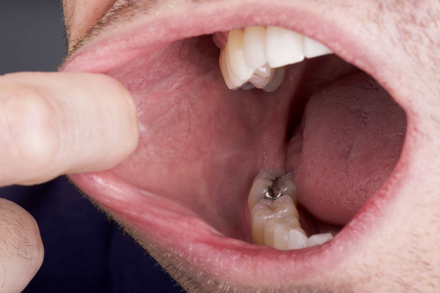 درمان شایع‌ترین سرطان دهان با حذف یک پروتئین ممکن می‌شود