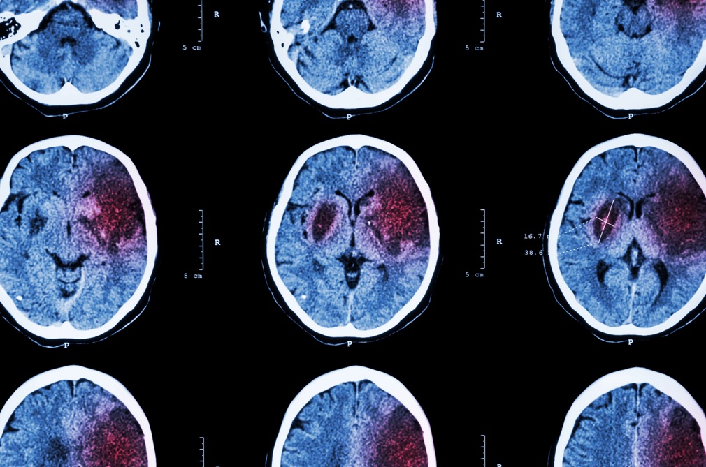یک تحقیق تازه نشان می‌دهد که «احتمالا» گاباپنتین برای درمان سکته مغزی، مفید است