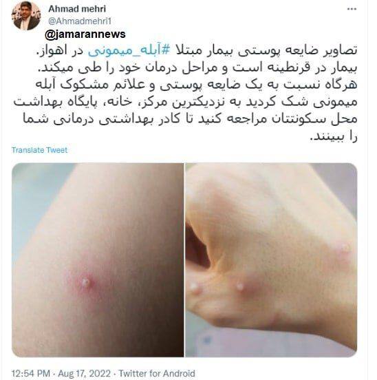 عکس ضایعه پوستی فرد مبتلا آبله میمونی در ایران