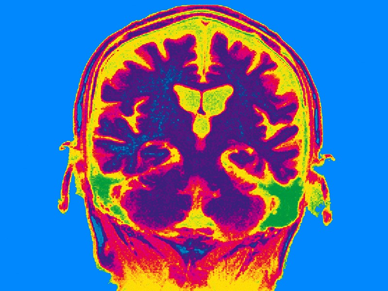 تحریک الکتریکی مغز می‌تواند حافظه افراد مسن را بهبود ببخشد