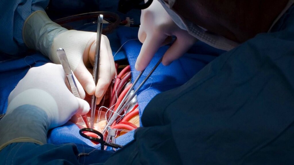 دستمزد عجیب جراحان قلب در بیمارستان‌های دولتی