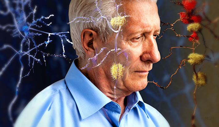 کشف تازه دربارۀ ارتباط «کابوس» و «آلزایمر»