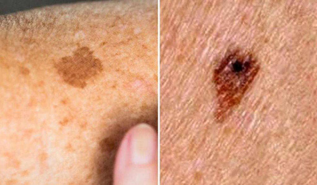 چگونه می توان تفاوت بین یک لکه پیری بی ضرر را با سرطان پوست تشخیص داد؟(روزیاتو)