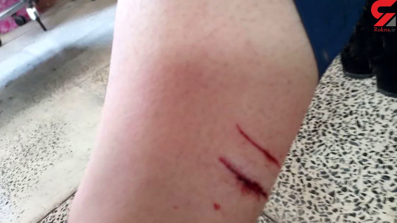 عکس دلخراش از حمله یک سگ به دانش آموز پرندی