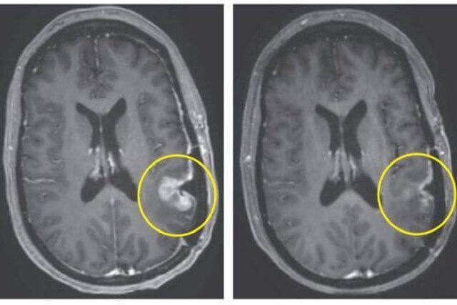 درمان باورنکردنی تومور مغزی تنها در 5 روز!