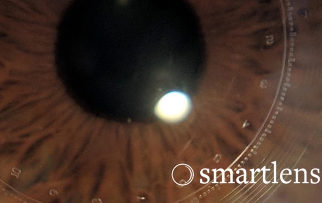 لنز تماسی miLens می‌تواند فشار داخل چشم بیماران مبتلا به گلوکوم را به صورت پیوسته اندازه‌گیری کند(یک پزشک)