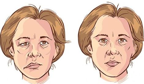 اختلالی که در زنان بالای ۴۰ سال شایع‌تر است و سمت چپ صورت را درگیر می‌کند (عصرایران)