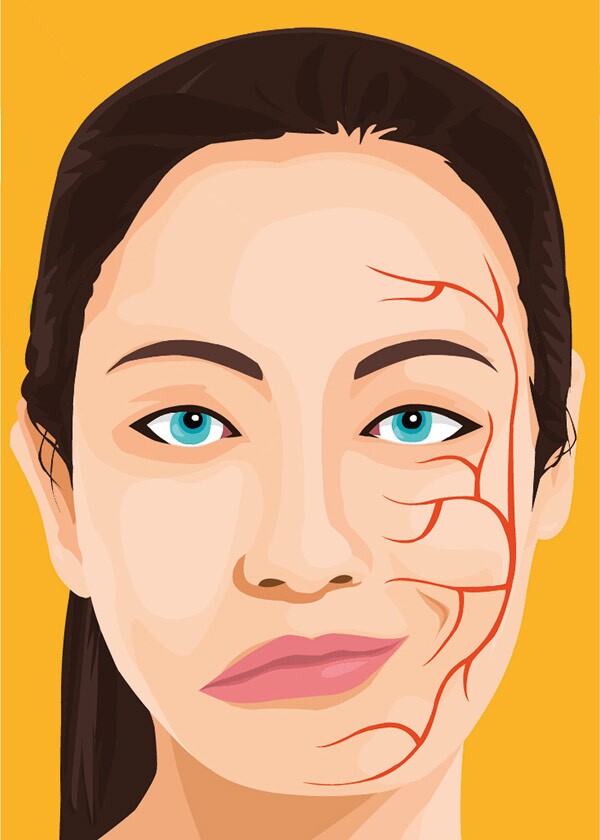 اختلالی که در زنان بالای ۴۰ سال شایع‌تر است و سمت چپ صورت را درگیر می‌کند (عصرایران)