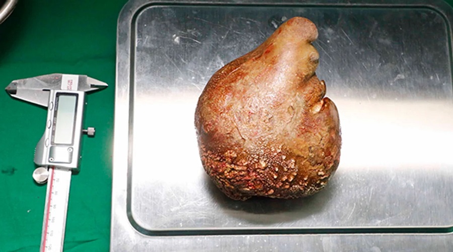 بزرگترین سنگ کلیه جهان به وزن ۸۰۰ گرم از بدن بیمار سریلانکایی بیرون آمد(روزیاتو)