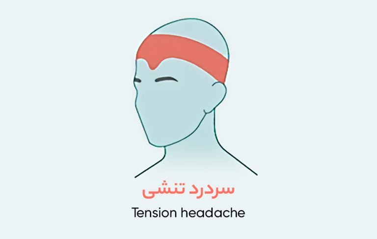سردرد در هر ناحیه از سر چه معنایی دارد ؟انواع سردرد و راه های درمان را بشناسید