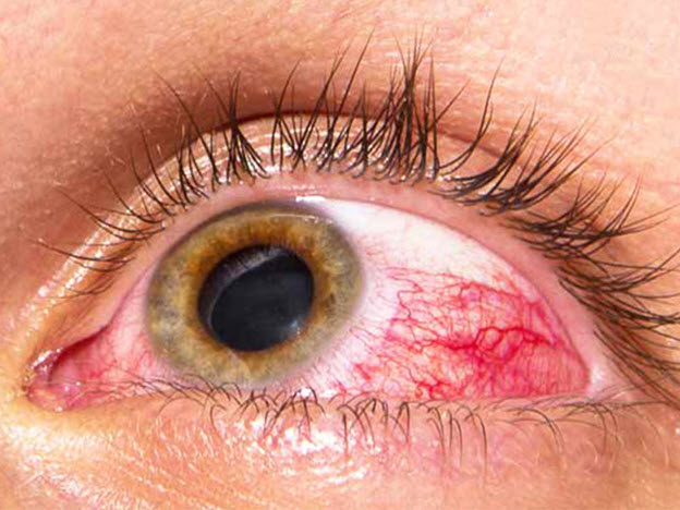 آیا فشار چشم خطرناک است؟ (یک پزشک)