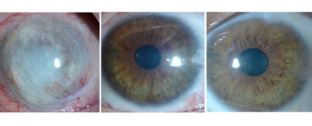 درمان پیشگامانه با سلول‌های بنیادی برای ترمیم آسیب‌های چشم (یک پزشک)