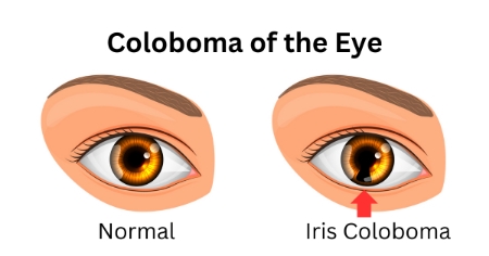 کولوبوم؛ همه چیز درباره این بیماری چشمی (بیتوته)
