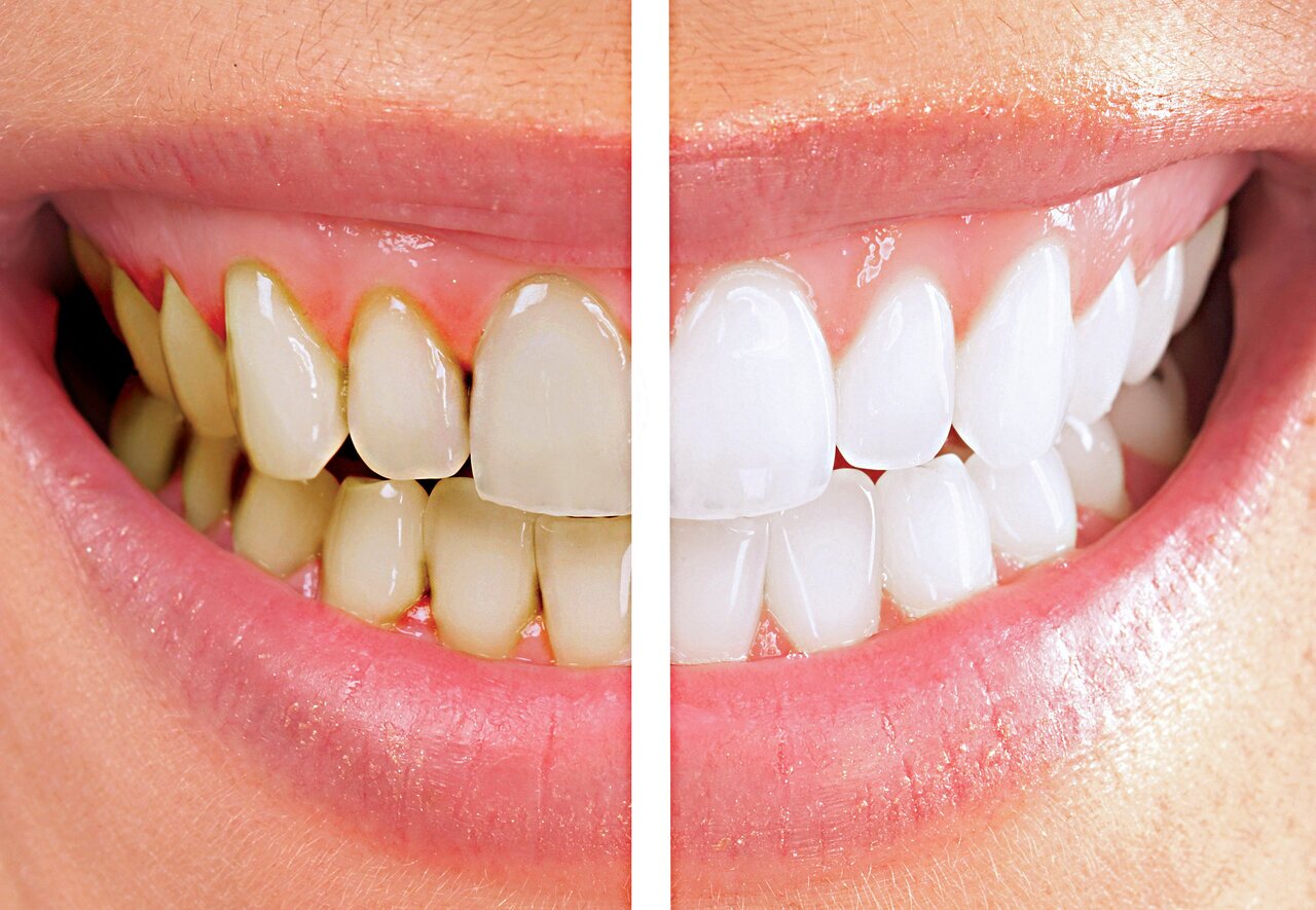 ۵ اشتباه رایجی که باعث زردی دندان ها می‌شود