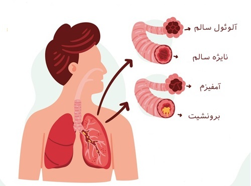 عوارض و علل بروز التهاب در ریه‌ها (صبح من)