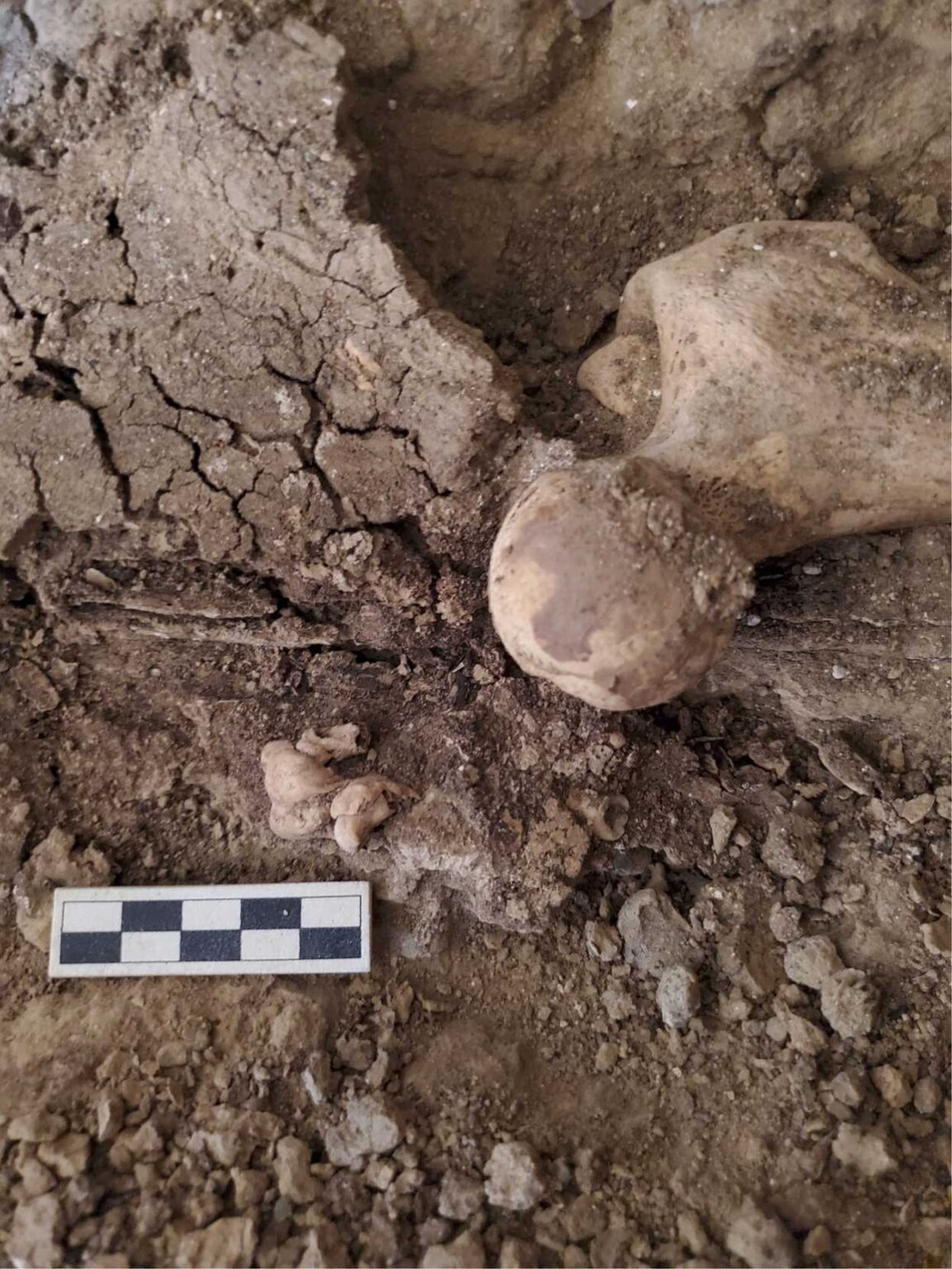 دندان توموری در لگن یک پیکر زن مصر باستان پیدا شد که ۱۴ قرن قبل از میلاد می‌زیست (یک پزشک)