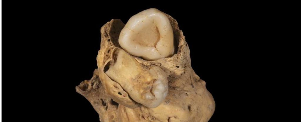 دندان توموری در لگن یک پیکر زن مصر باستان پیدا شد که ۱۴ قرن قبل از میلاد می‌زیست (یک پزشک)