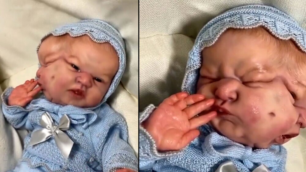 تولد یک کودک با ۲ سر همه را شوکه کرد