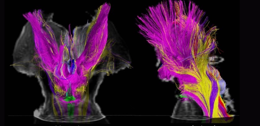 با استفاده از اسکن MRI، دانشمندان حالا می‌توانند توضیح بدهند که چه چیزی باعث تغییر وضعیت هوشیاری می‌شود (یک پزشک)