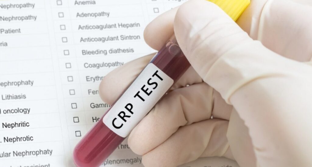 آزمایش CRP چیست و چرا تجویز می‌شود؟ (روزیاتو)