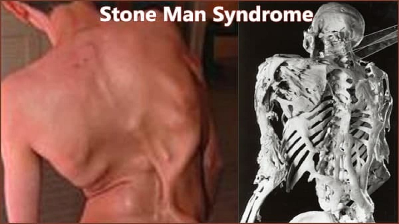 بیماری سندرم مرد سنگی چیست؟ (عصرایران)
