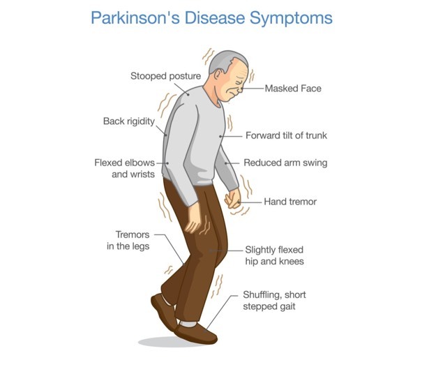 با یک آزمایش جدید، بیماری پارکینسون را می‌توان ۷ سال قبل از بروز علائم آن تشخیص داد (یک پزشک)