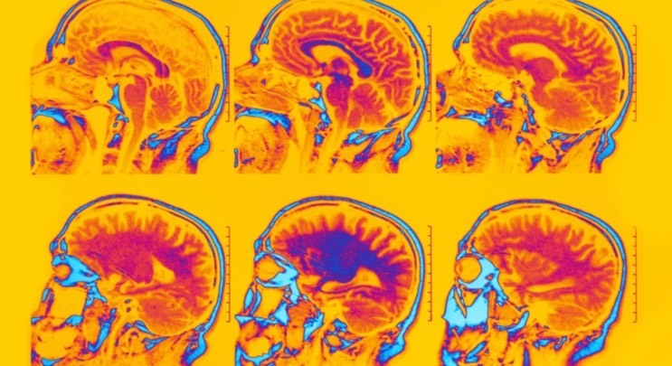 با اسکن مغز fMRI، شش نوع متمایز از افسردگی و اضطراب، شناسایی شد (یک پزشک)