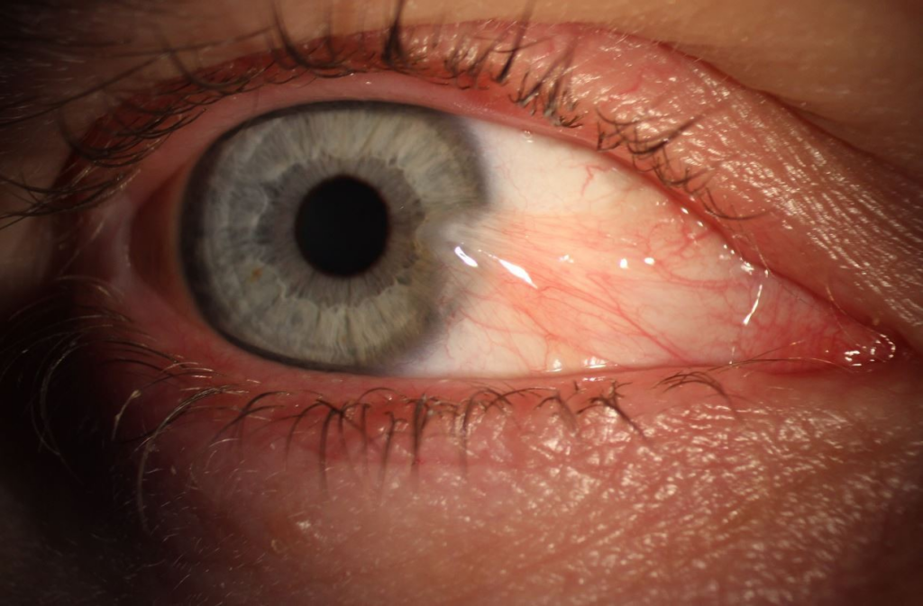 ناخنک چشم چیست؟ آیا روشی خانگی برای درمان ناخنک چشم وجود دارد؟ (روزیاتو)
