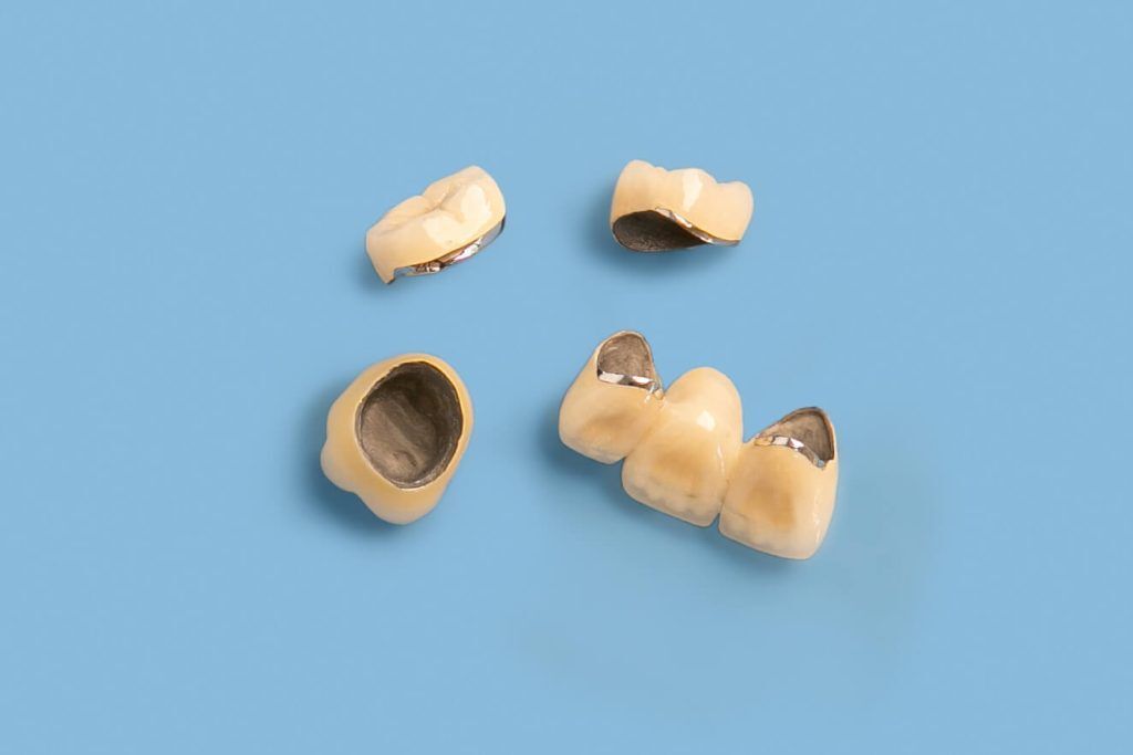 هزینه روکش دندان عصب کشی شده در سال 1403