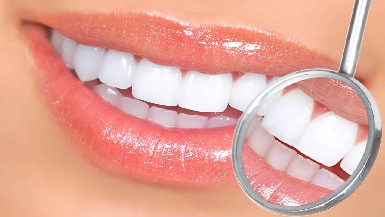 عمر لمینت دندان چقدر است؟ | ۸ راهکار اساسی برای افزایش ماندگاری لمینت