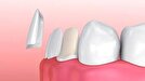 عمر لمینت دندان چقدر است؟
