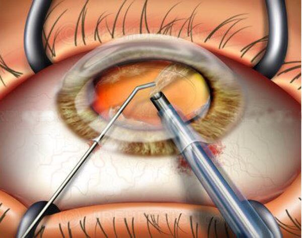 درمان نوین آب‌مروارید: جایگزینی برای جراحی چشم (البته نه در همه موارد) (یک پزشک)