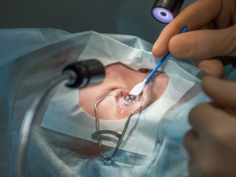 درمان نوین آب‌مروارید: جایگزینی برای جراحی چشم (البته نه در همه موارد) (یک پزشک)